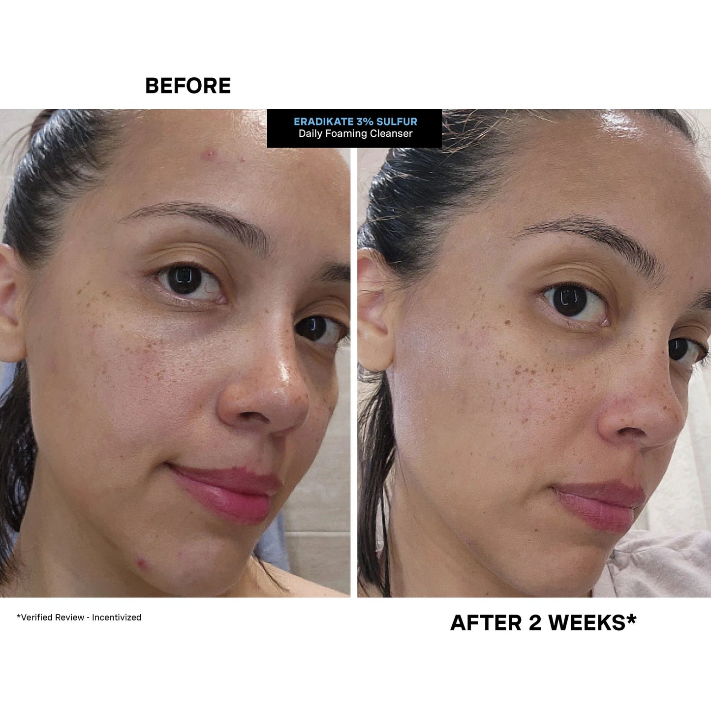 Eradikate® 3% Sulfur Daily Foaming Cleanser